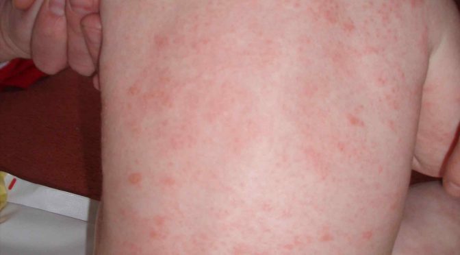 Prevention and Treatment of Childhood Eczema Through Lactobacillus rhamnosus HN001